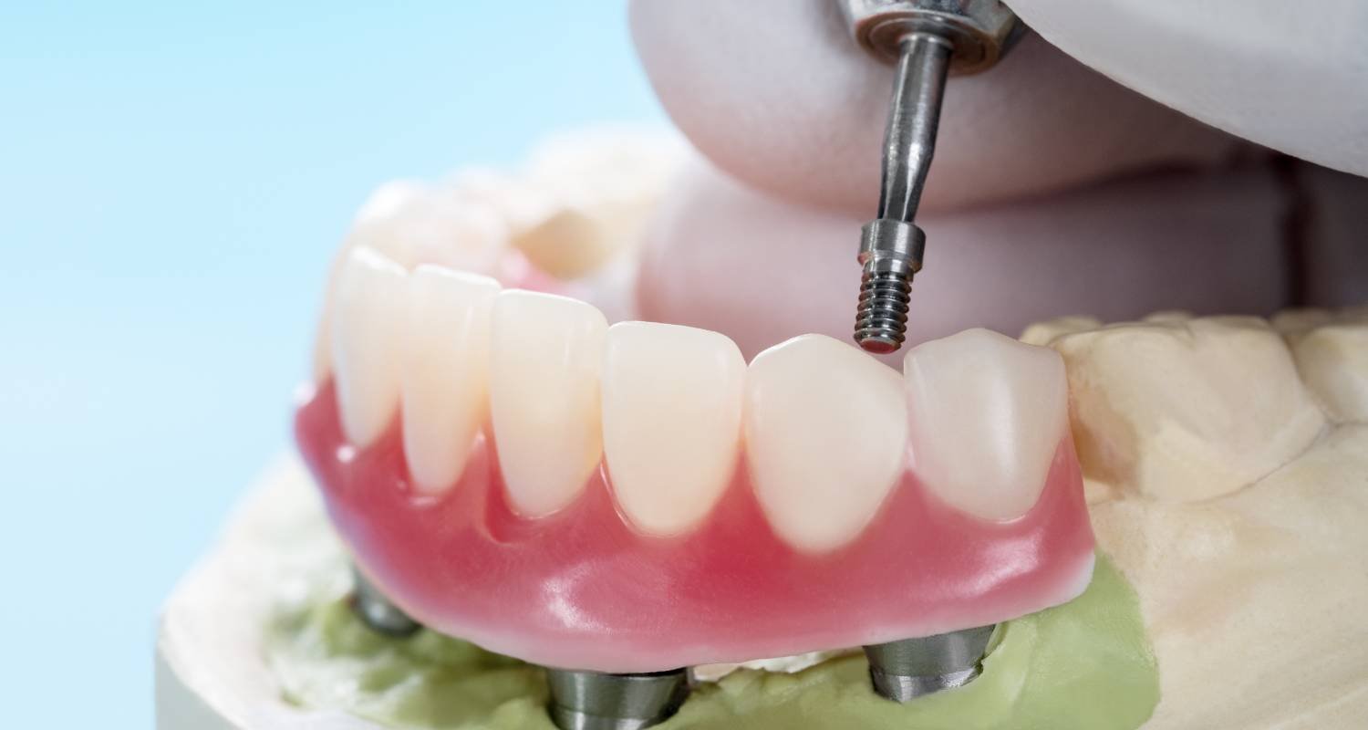 Dental Implants Visual Guide